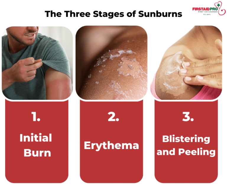 Sunburn Example Slip Slop Slap Seek And Slide - Be SunSmart - FirstAidPro