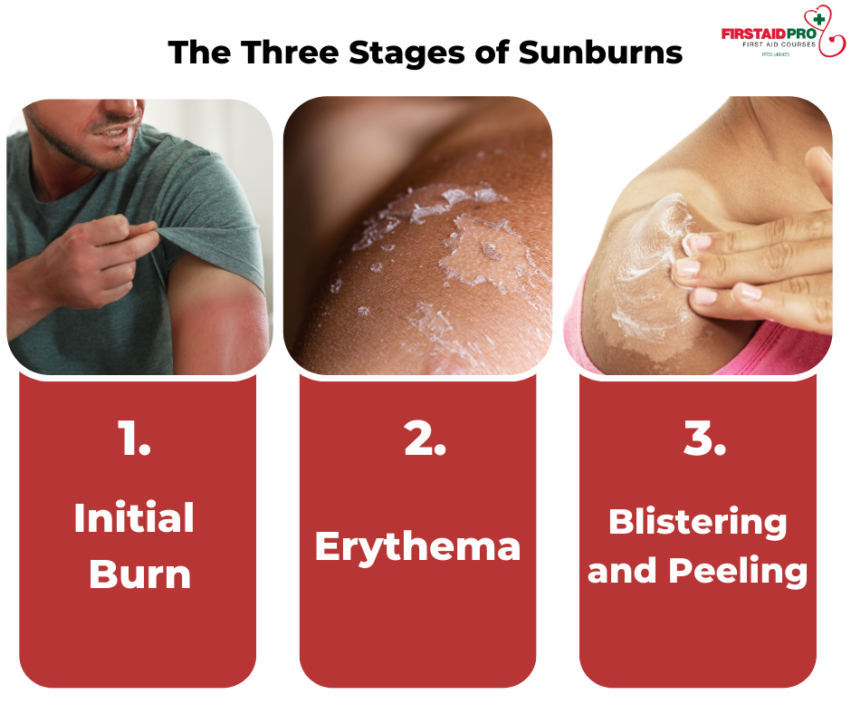 The Three Stages of Sunburns
