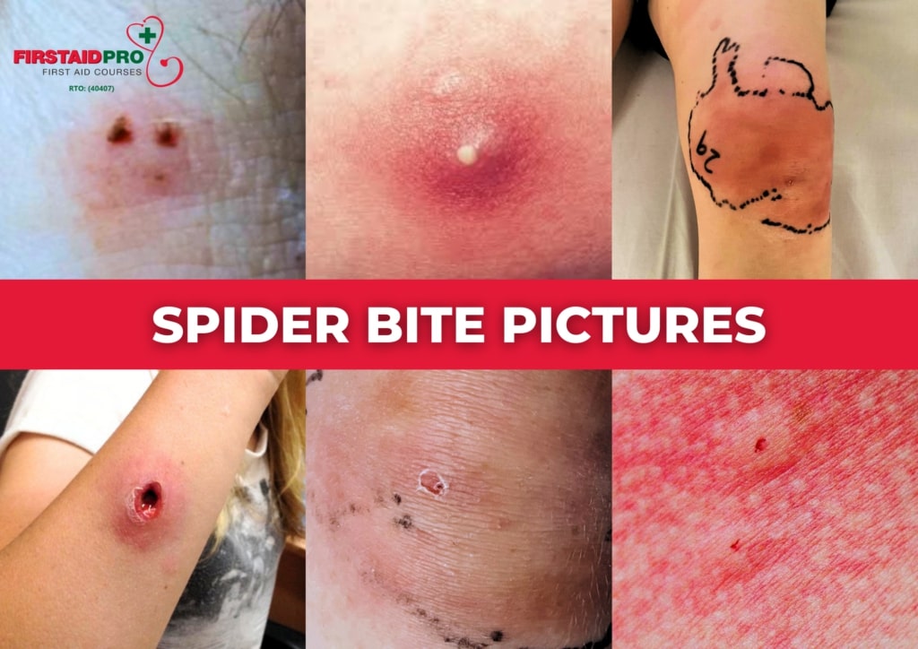 spider bite symptoms