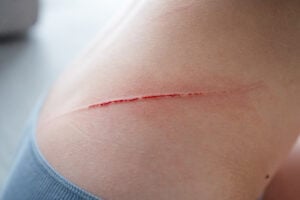 prevent wound infection