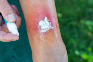 best ointment for burns, best ointments for burns