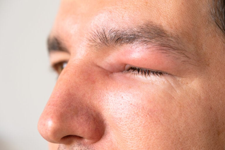 Kids' Eye Injury First Aid Tips for Effective Treatment