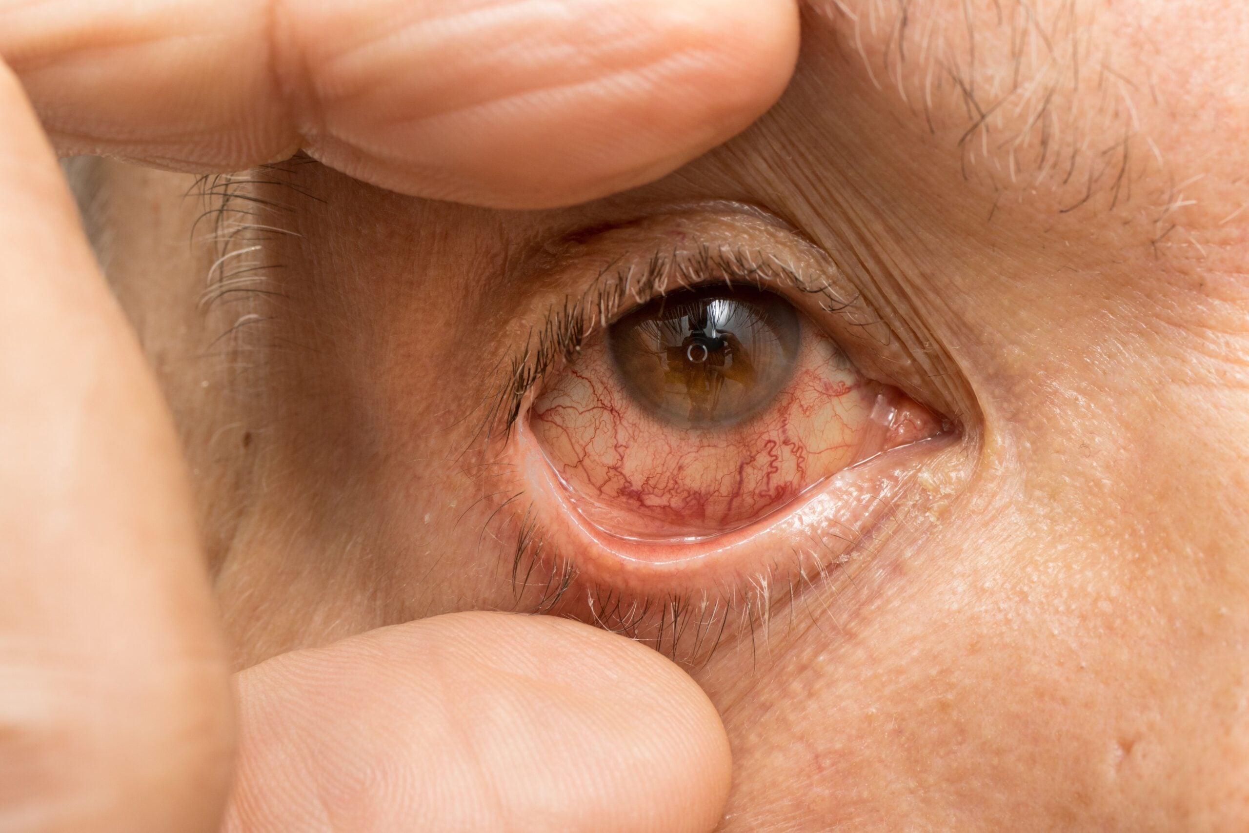 Handle Eye Injuries