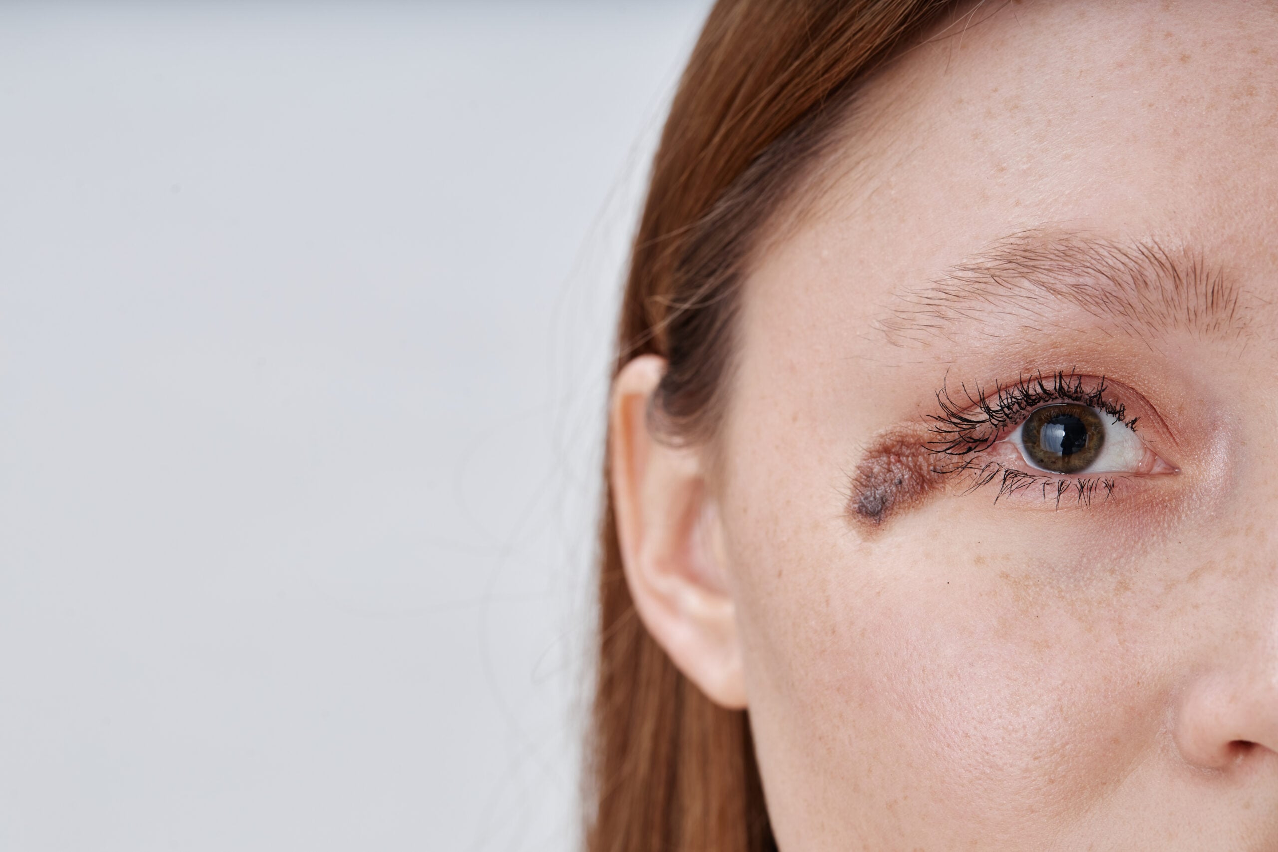 Extreme close up on unique facial birthmark of young woman looking at camera with confidence embracing authenticity of natural skin while posing against white background in studio, copy space