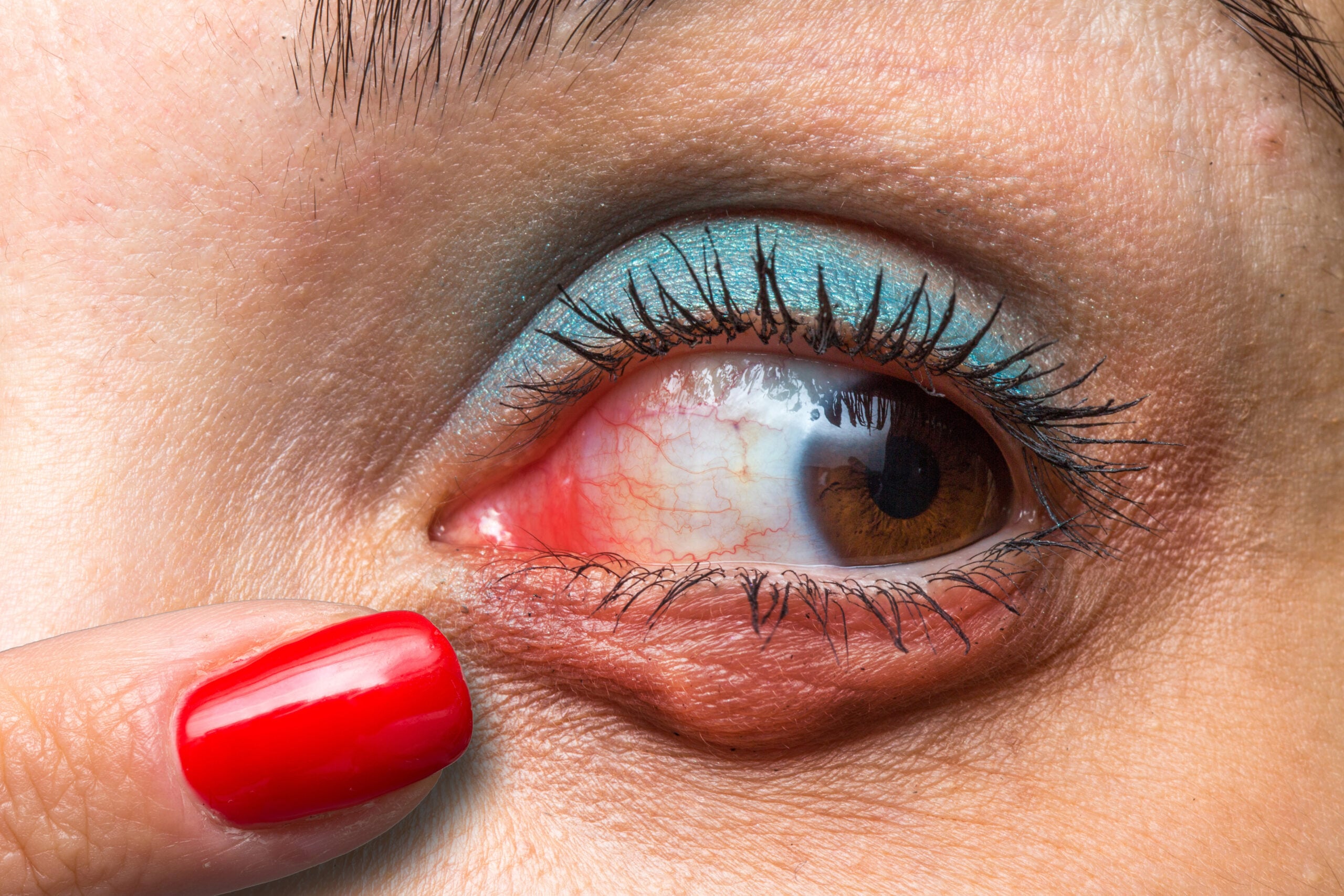 Macro of a makeup eye of a woman suffering from chalazion, finger with red nail polish indicating redness and swelling of the eye