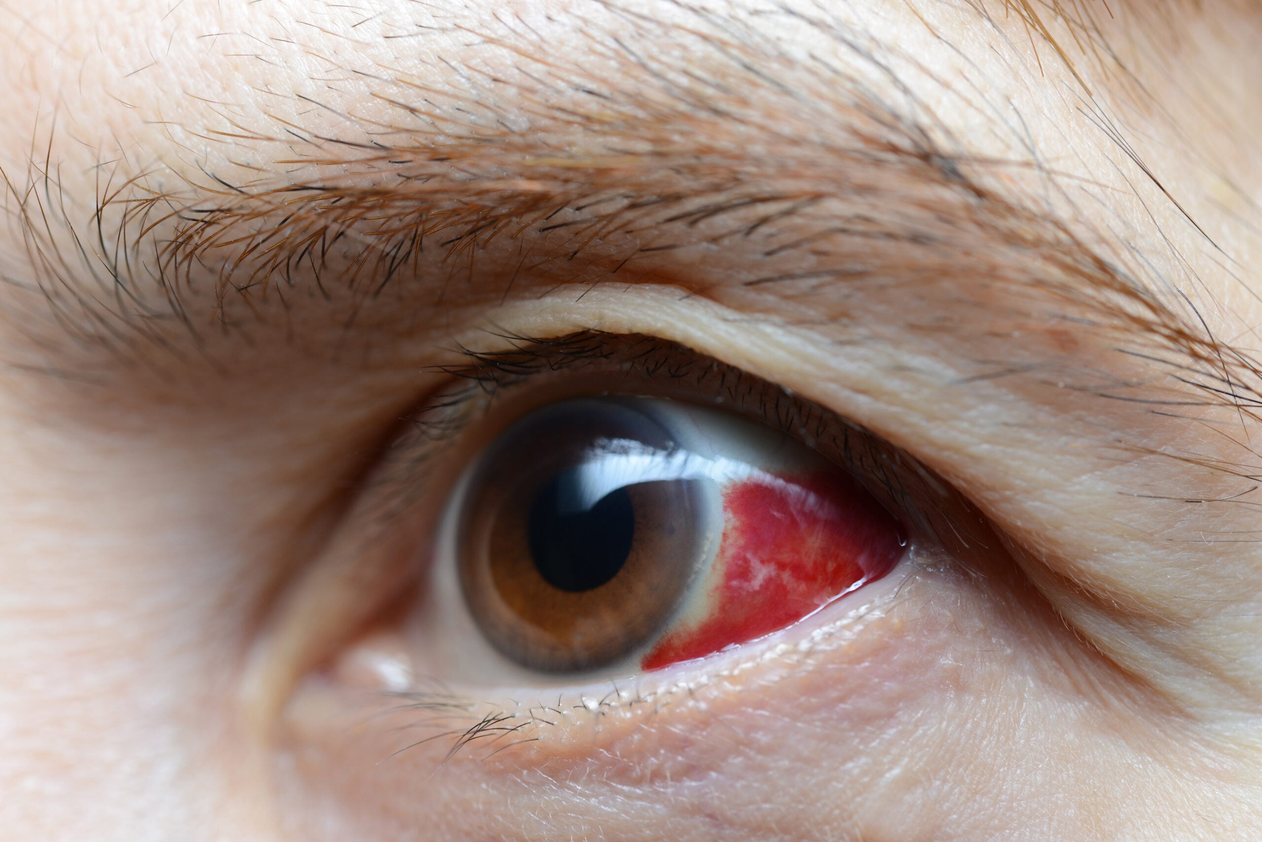 Woman with burst blood vessel in eye, closeup