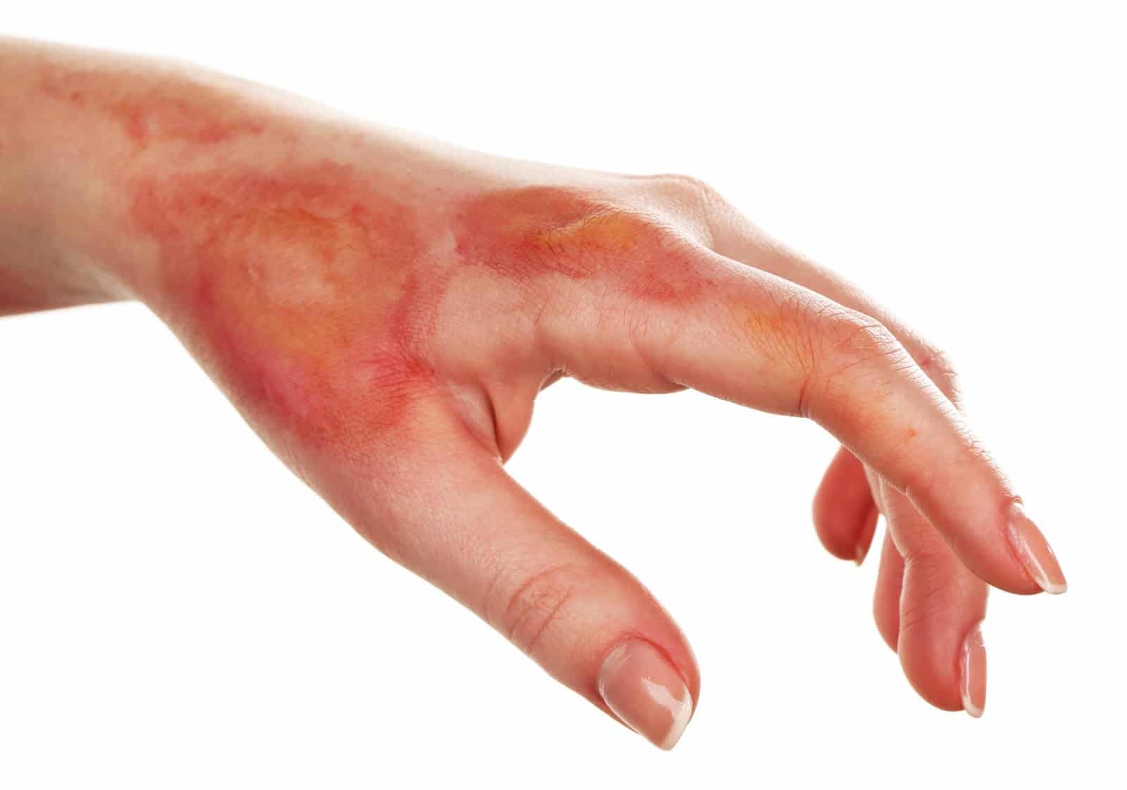treating minor burns