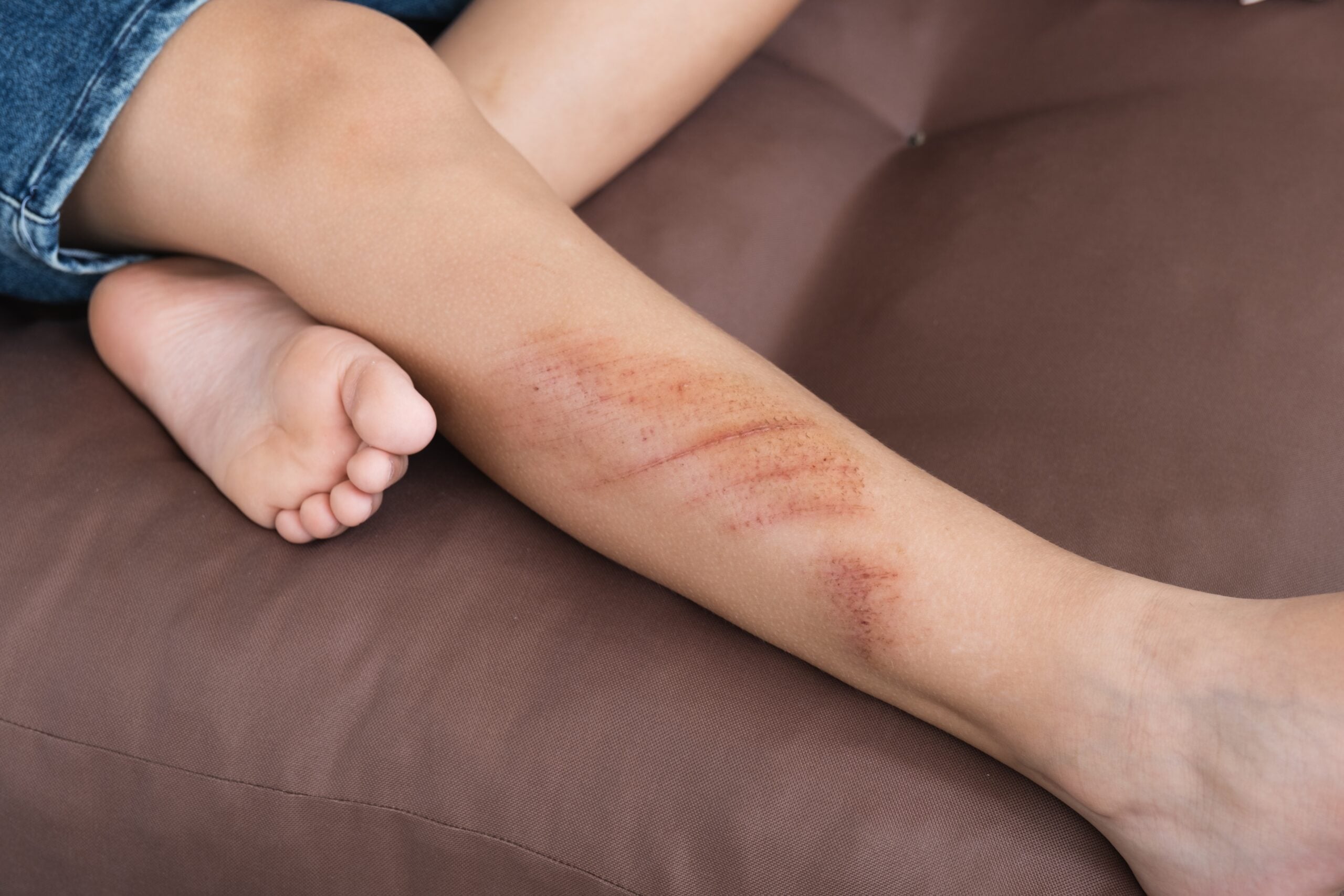 Snake Bite Response Critical First Aid Treatment Steps