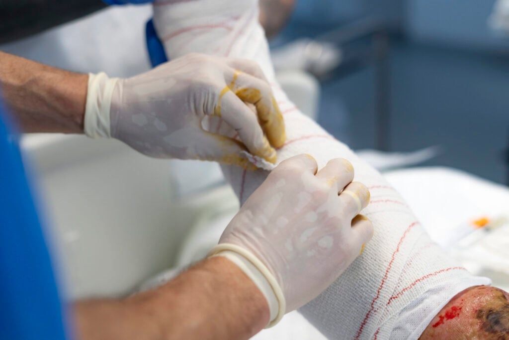 NDIS Complex Wound Care