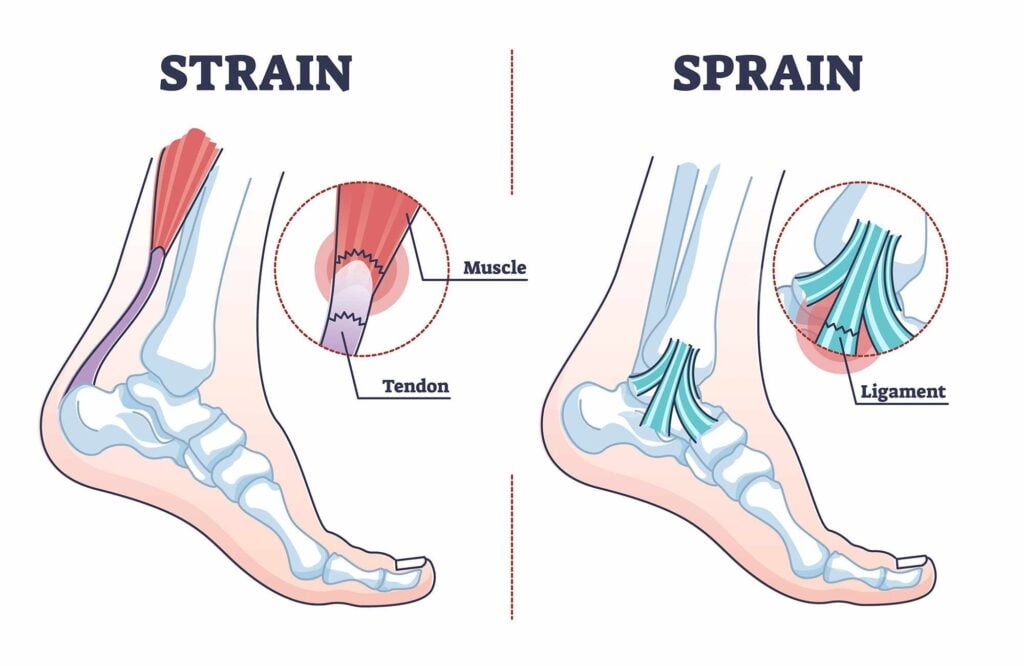 The-Difference-Between-A-Sprain-And-A-Strain
