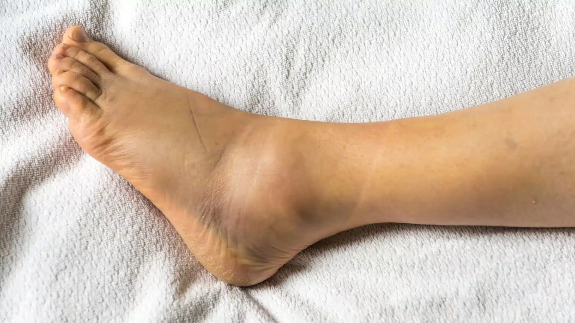 sprain of the ankle