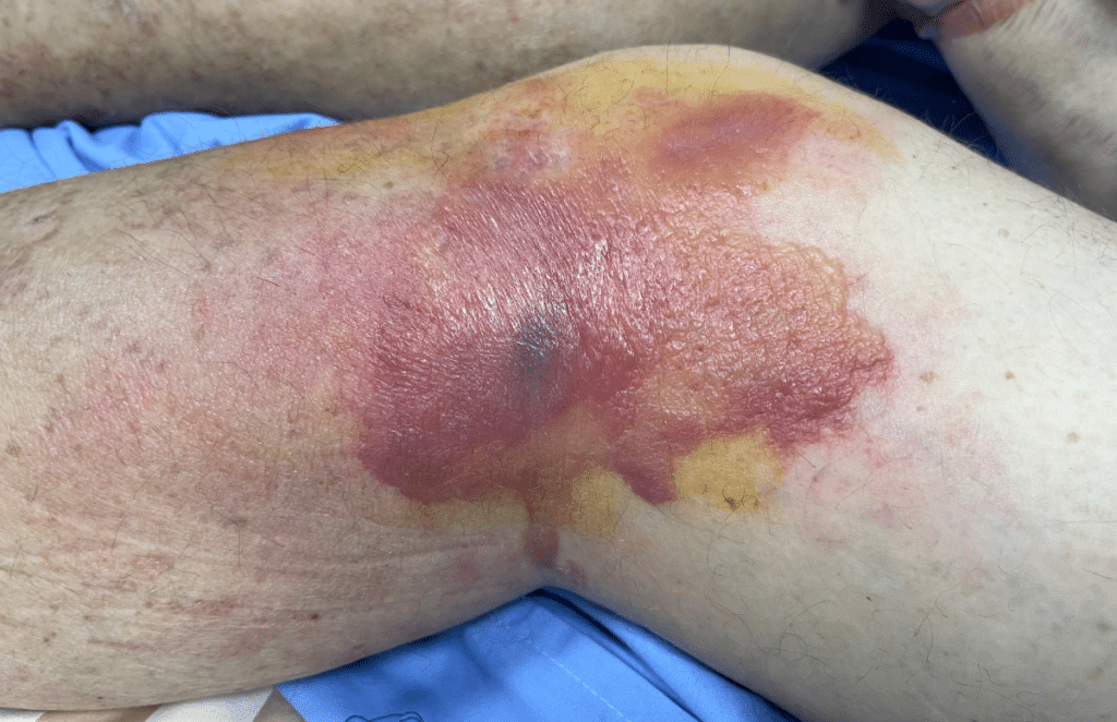 soft tissue injury - bruise