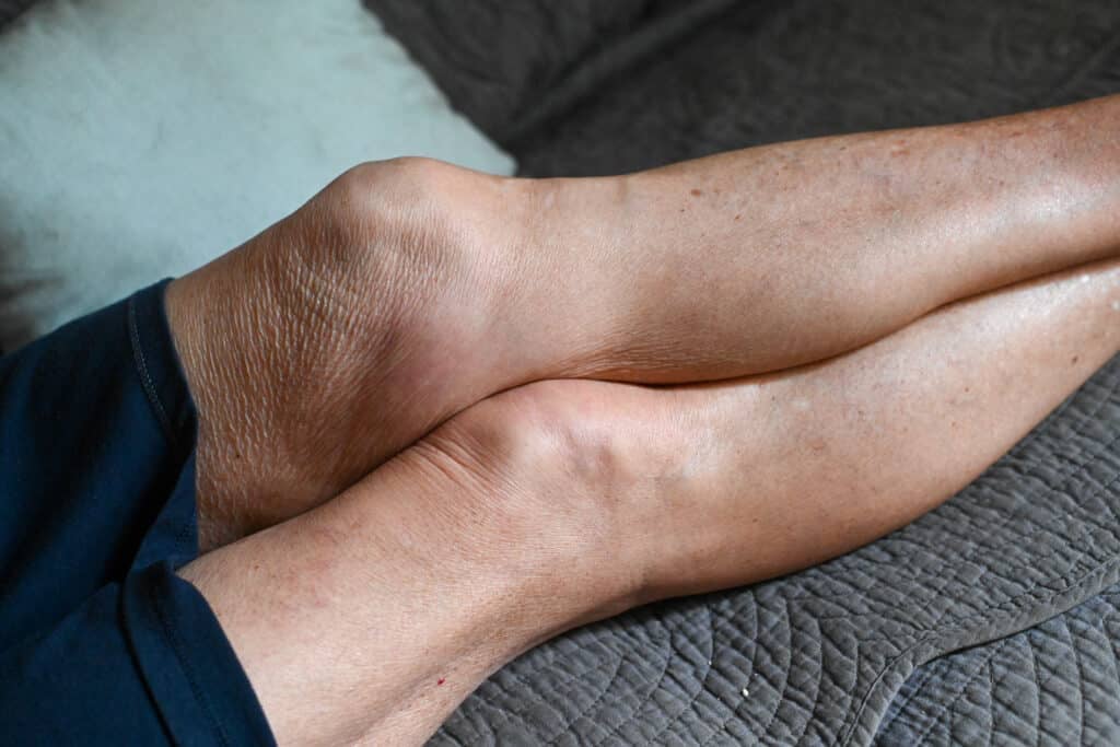 senior woman leg with medical condition, ostheo arthritis inflammation swollen joints and limbs