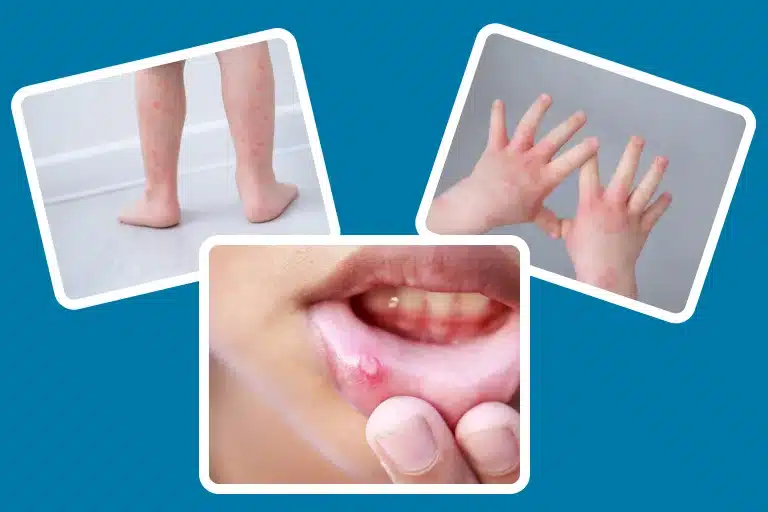 Hand Foot and Mouth-Disease