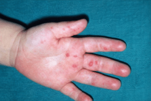 Hand foot and mouth disease treatment