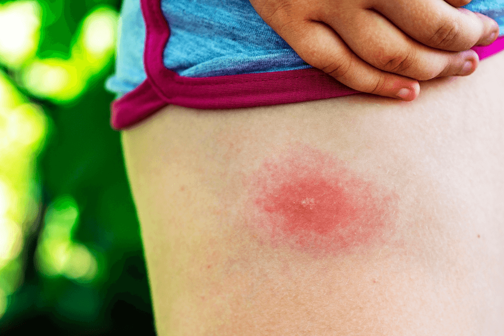 Tick-bites