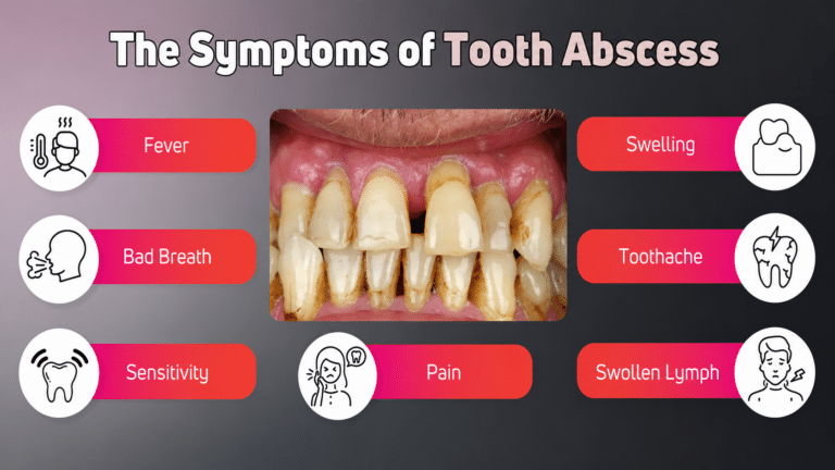 Tooth Abscess – Everything You Need to Know - FirstAidPro