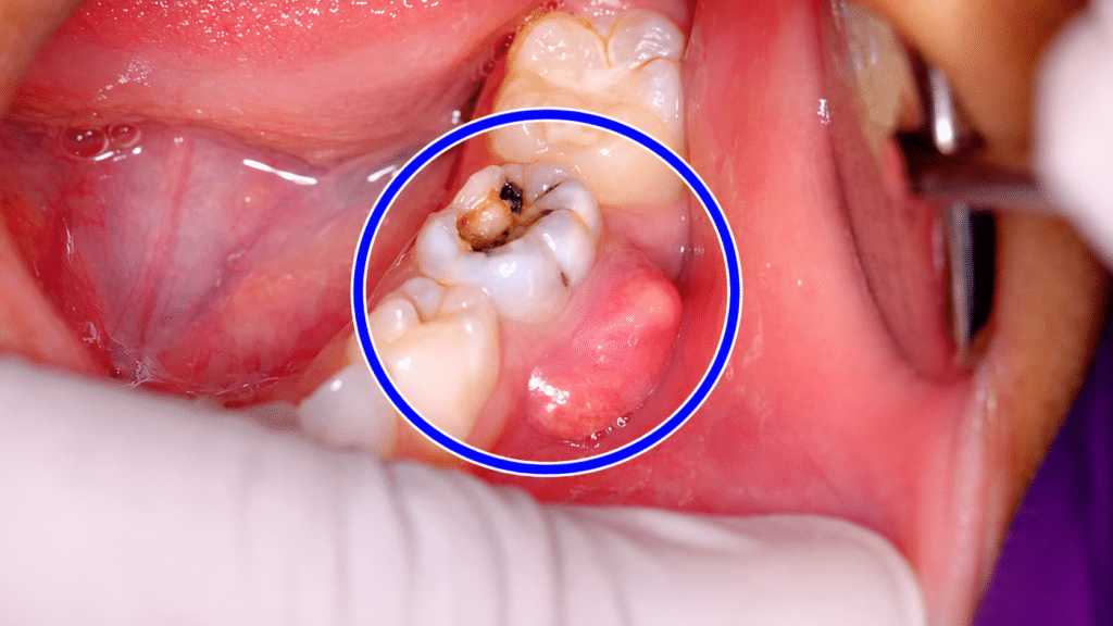 Tooth abscess sources decayed crown of tooth