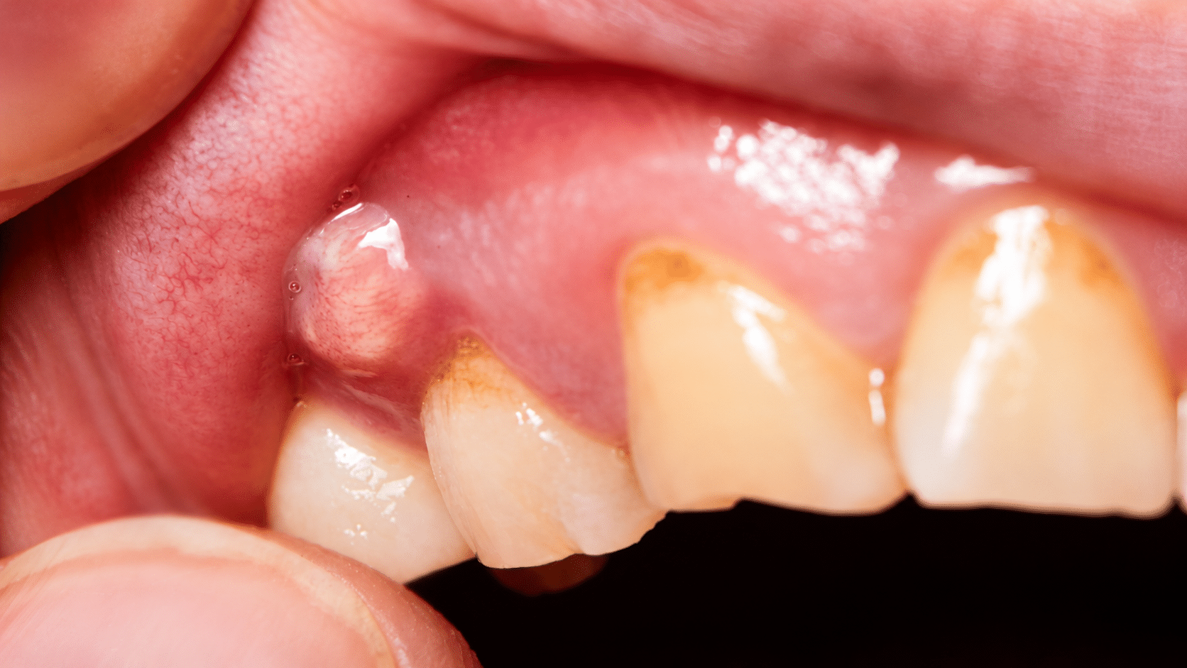 Tooth abscess