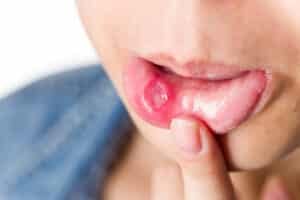 mouth ulcer - Woman with serious mouth ulcer