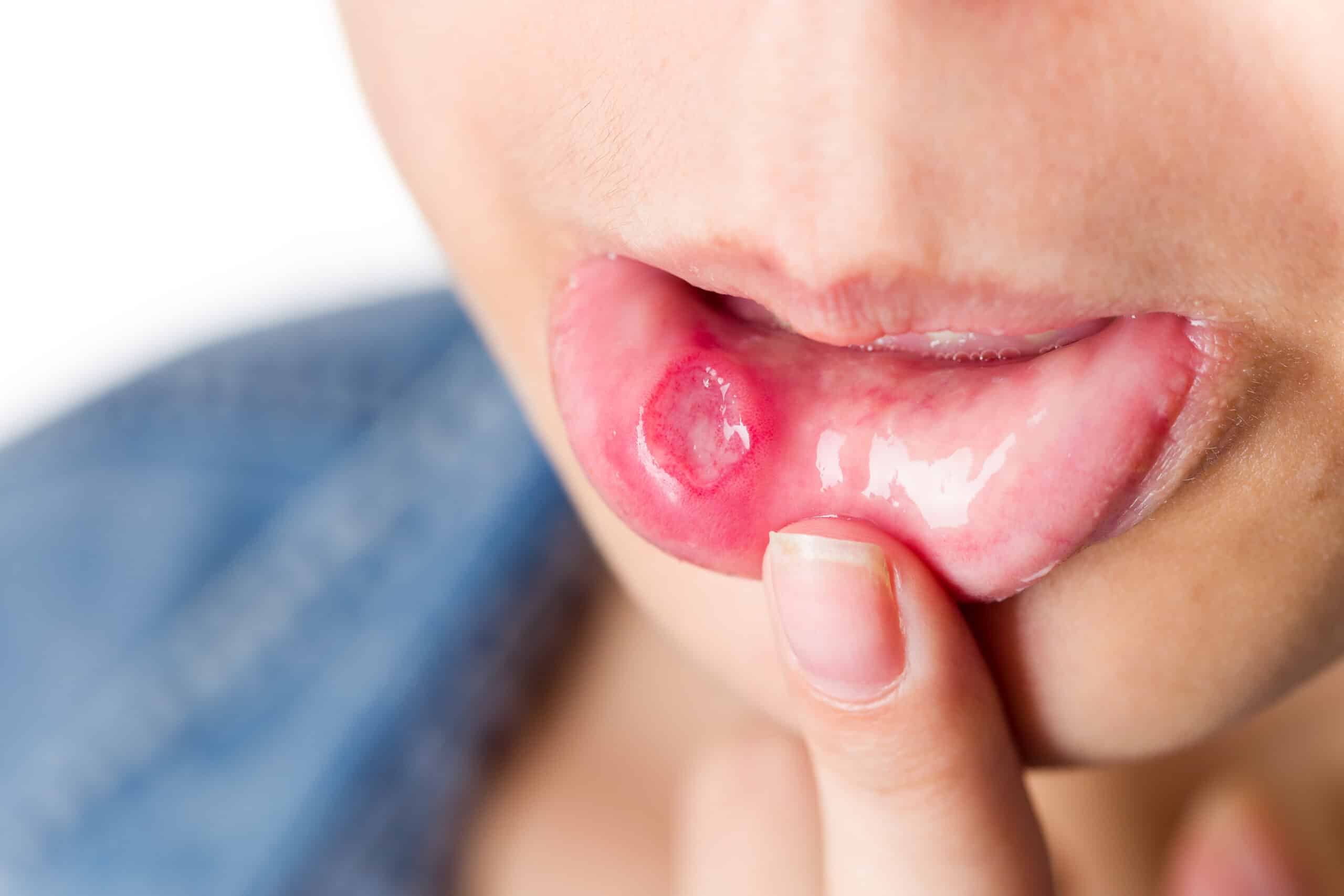 mouth ulcer - Woman with serious mouth ulcer