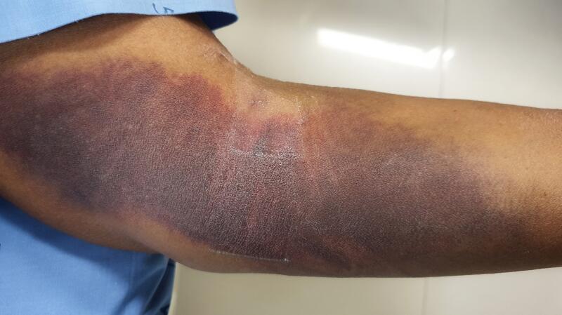 internal bleeding - bruising effect on man's arm